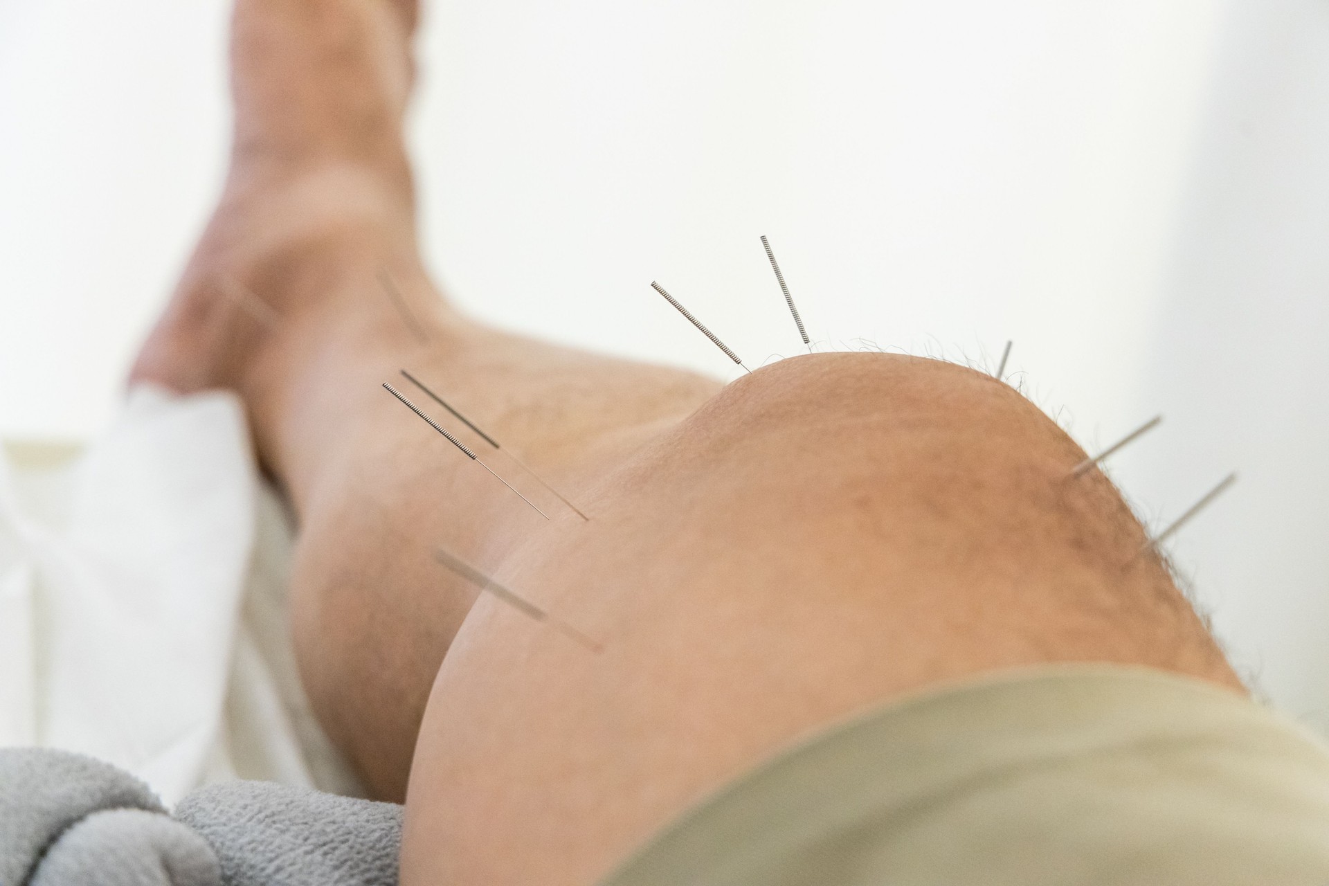 Closeup of acupuncture needles on thigh of Chinese man during acupuncture treatment