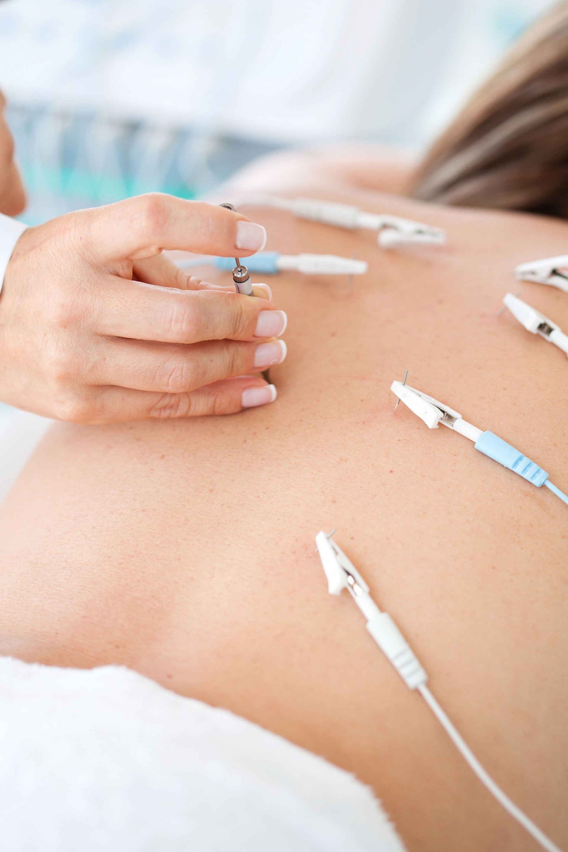 Doctor applying electroacupuncture on a patient's back
